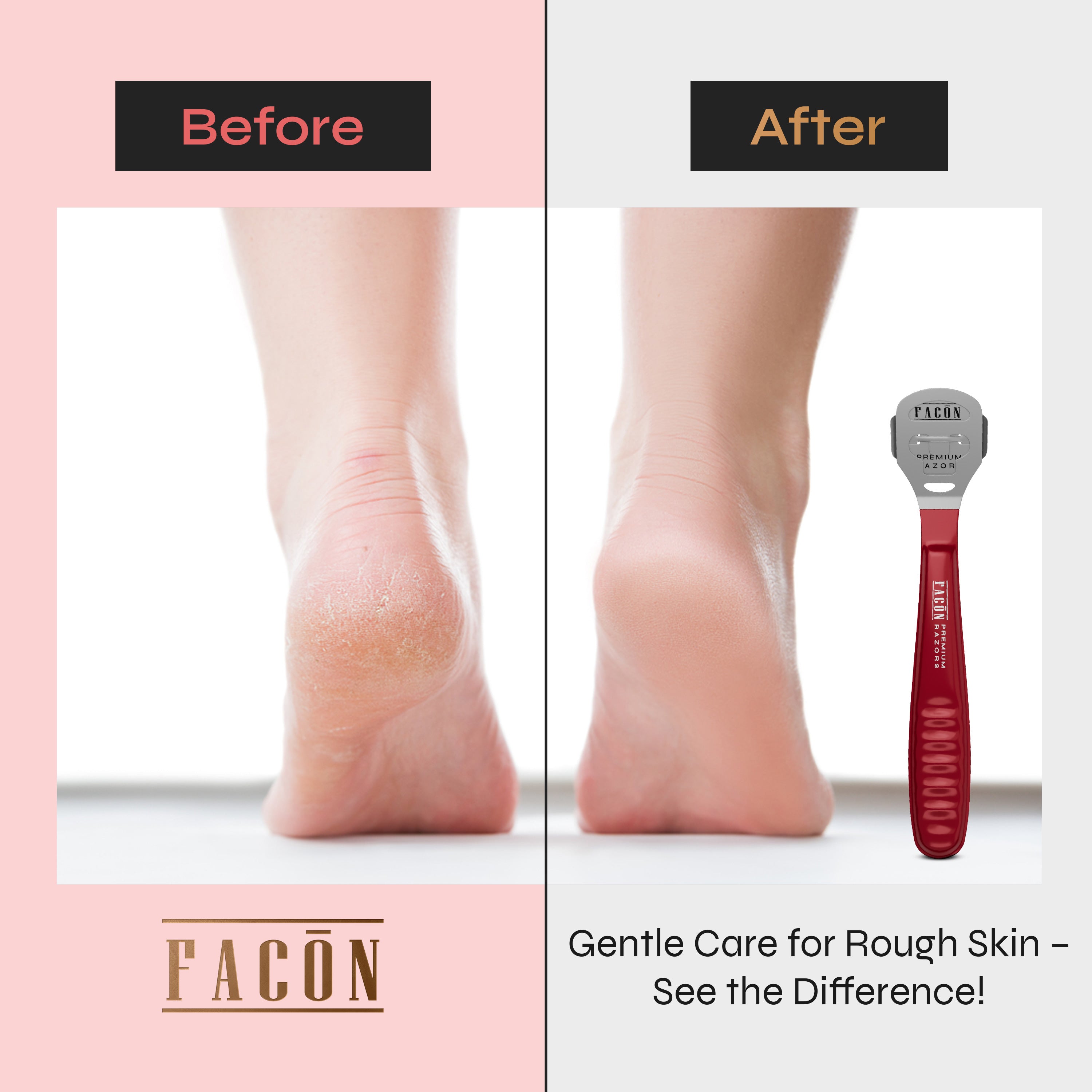 Facón Professional Callus Shaver Remover with 50 Blades, Pedicure Razor for Feet & Hands, Foot Razor for Callus Removal, Callus Blade Remover, Corn Shaver, Surgical Grade Premium Stainless Steel Tool