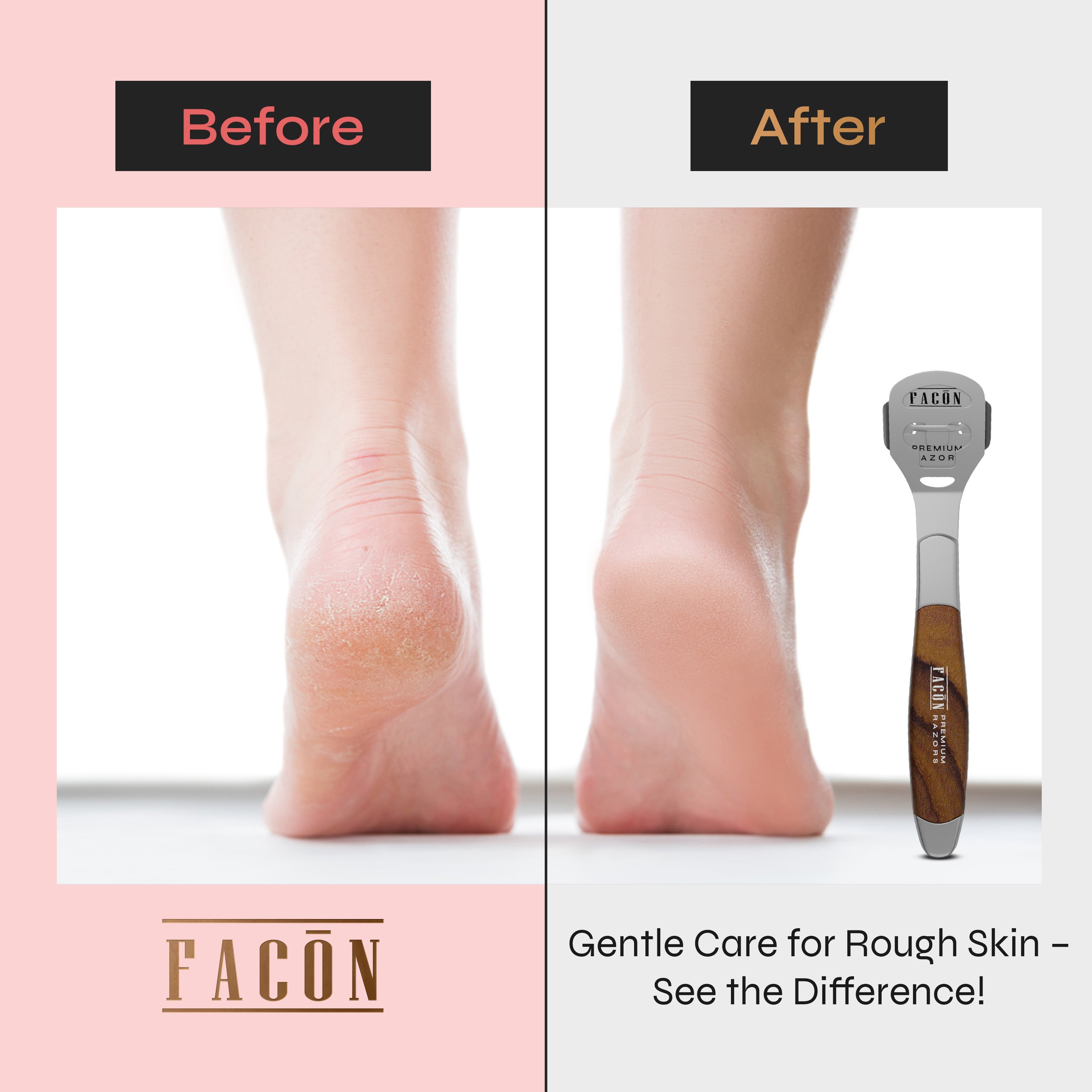 Facón Professional Callus Shaver Remover with 50 Blades, Pedicure Razor for Feet & Hands, Foot Razor for Callus Removal, Callus Blade Remover, Corn Shaver, Surgical Grade Premium Stainless Steel Tool