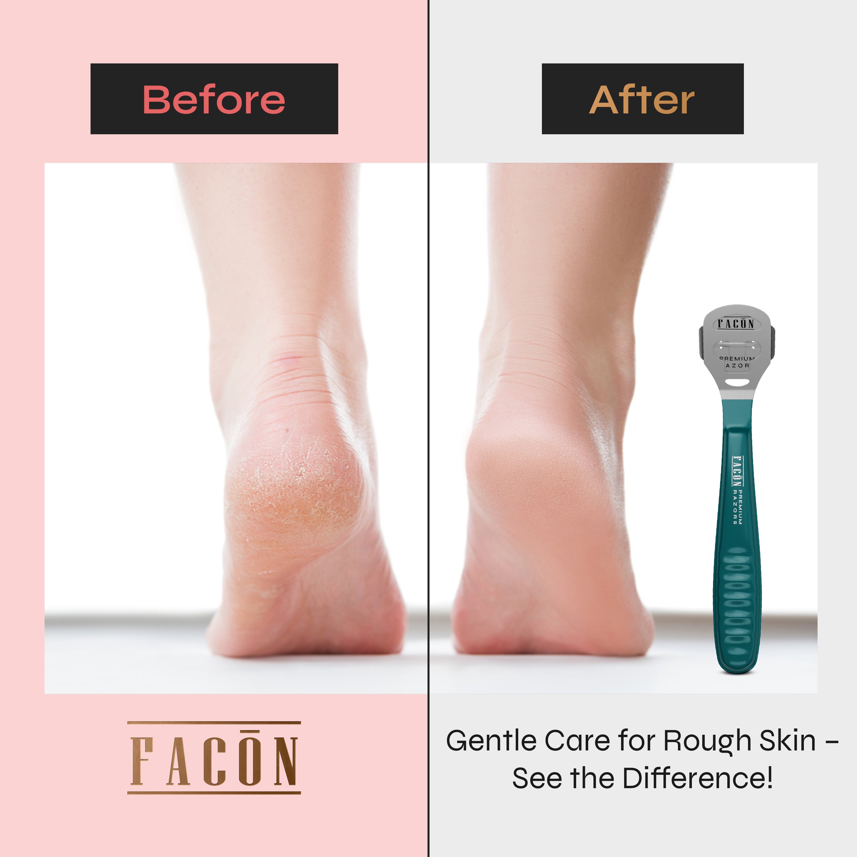 Facón Professional Callus Shaver Remover with 50 Blades, Pedicure Razor for Feet & Hands, Foot Razor for Callus Removal, Callus Blade Remover, Corn Shaver, Surgical Grade Premium Stainless Steel Tool