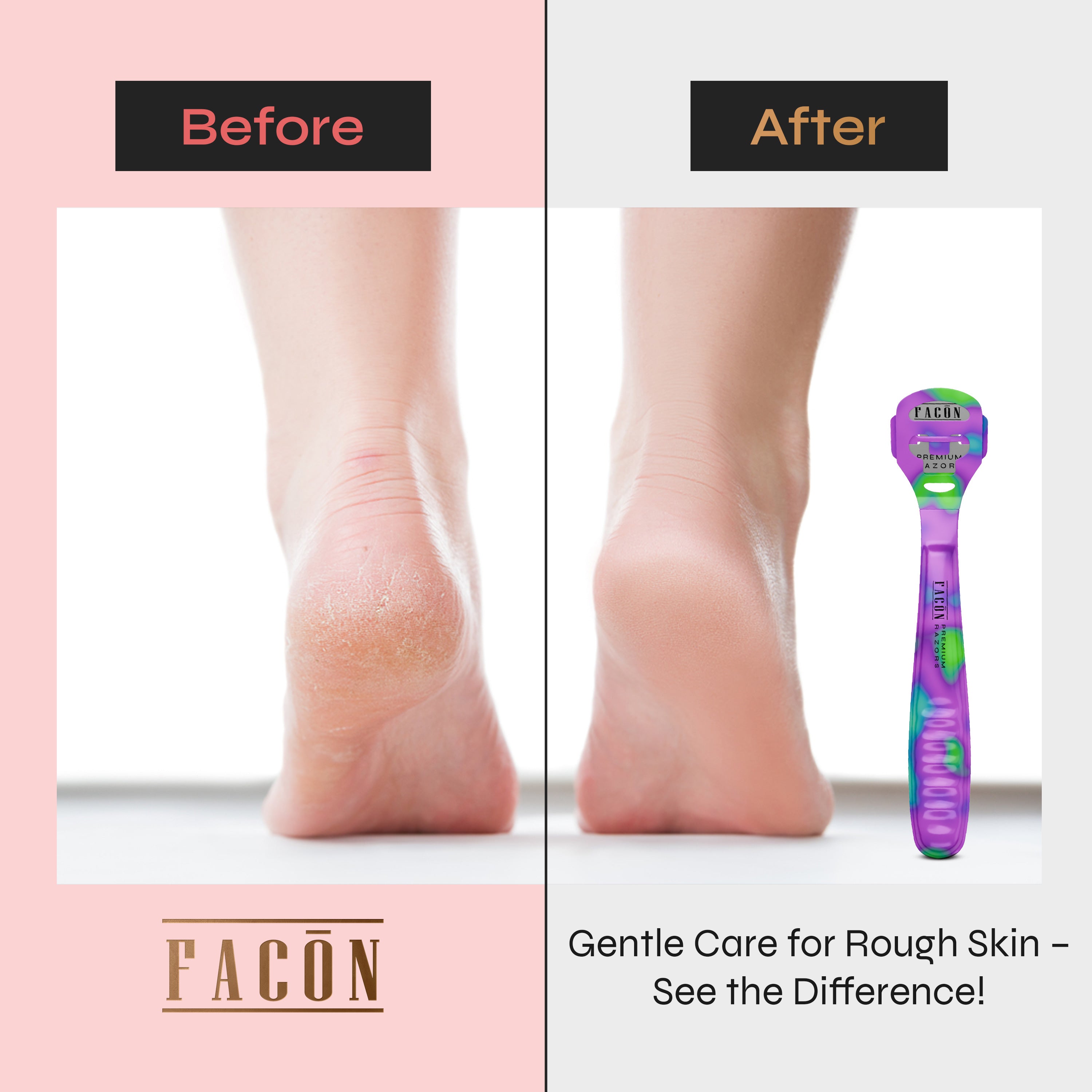 Facón Professional Callus Shaver Remover with 50 Blades, Pedicure Razor for Feet & Hands, Foot Razor for Callus Removal, Callus Blade Remover, Corn Shaver, Surgical Grade Premium Stainless Steel Tool