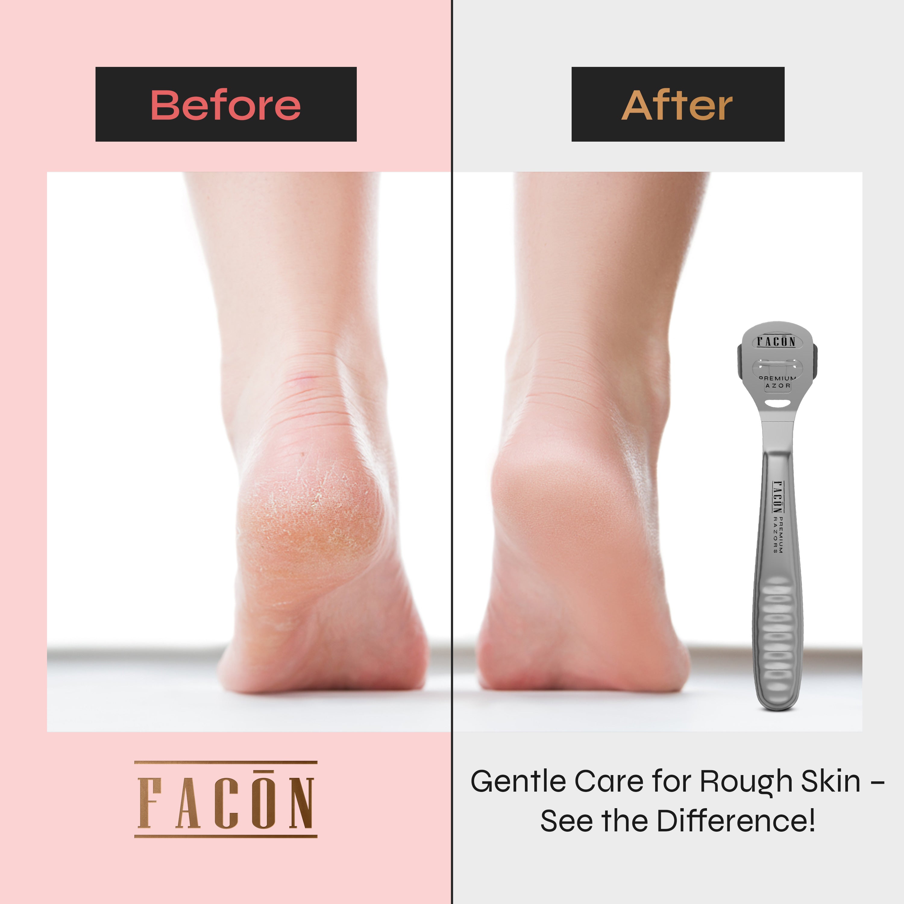 Facón Professional Callus Shaver Remover with 50 Blades, Pedicure Razor for Feet & Hands, Foot Razor for Callus Removal, Callus Blade Remover, Corn Shaver, Surgical Grade Premium Stainless Steel Tool