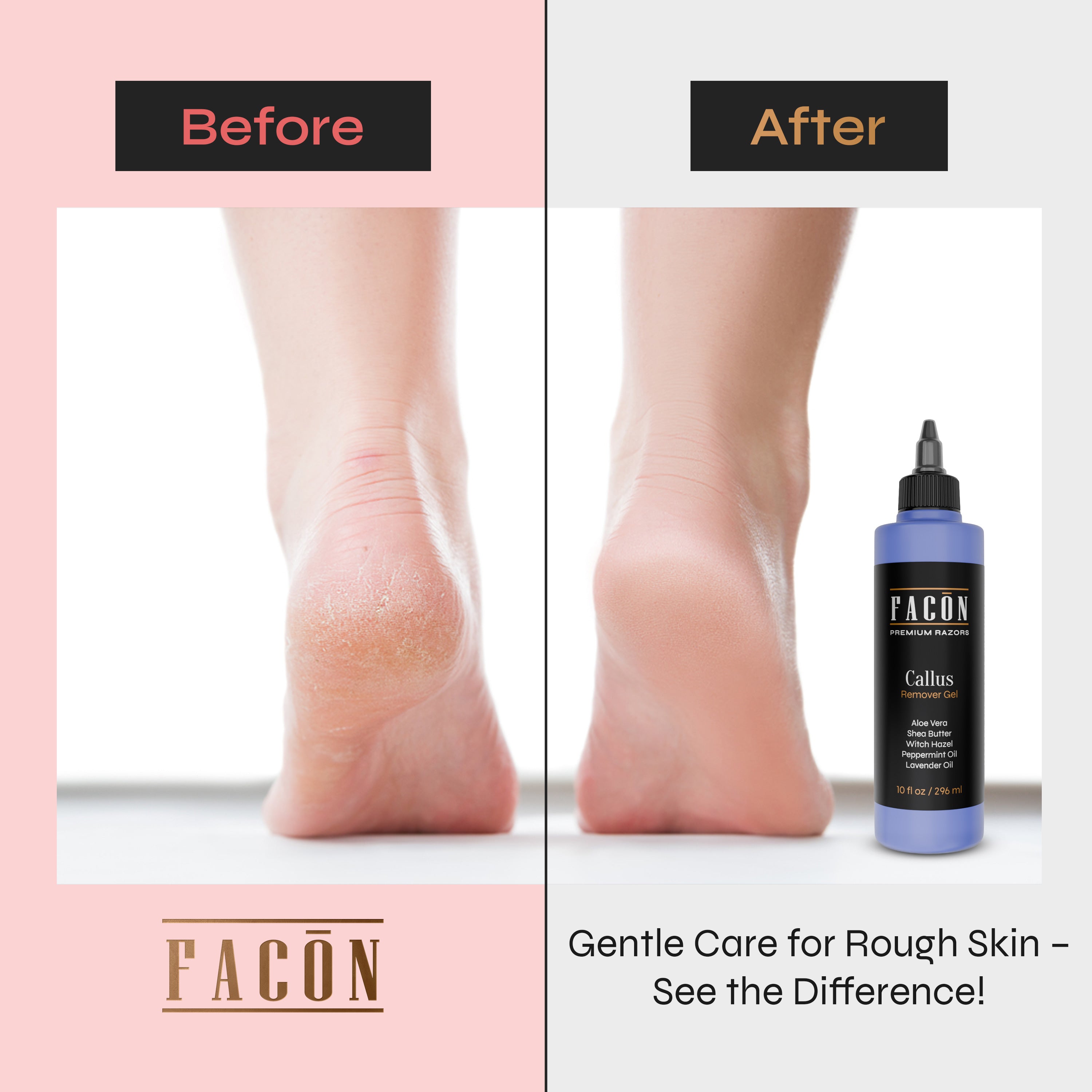 Facón Professional Callus Remover Gel for Feet with Aloe Vera, Shea Butter, Peppermint & Witch Hazel, Lavender Scent Callus Softener, Home Pedicure Foot Spa, Removes Cracked & Dead Dry Skin, 10 fl oz