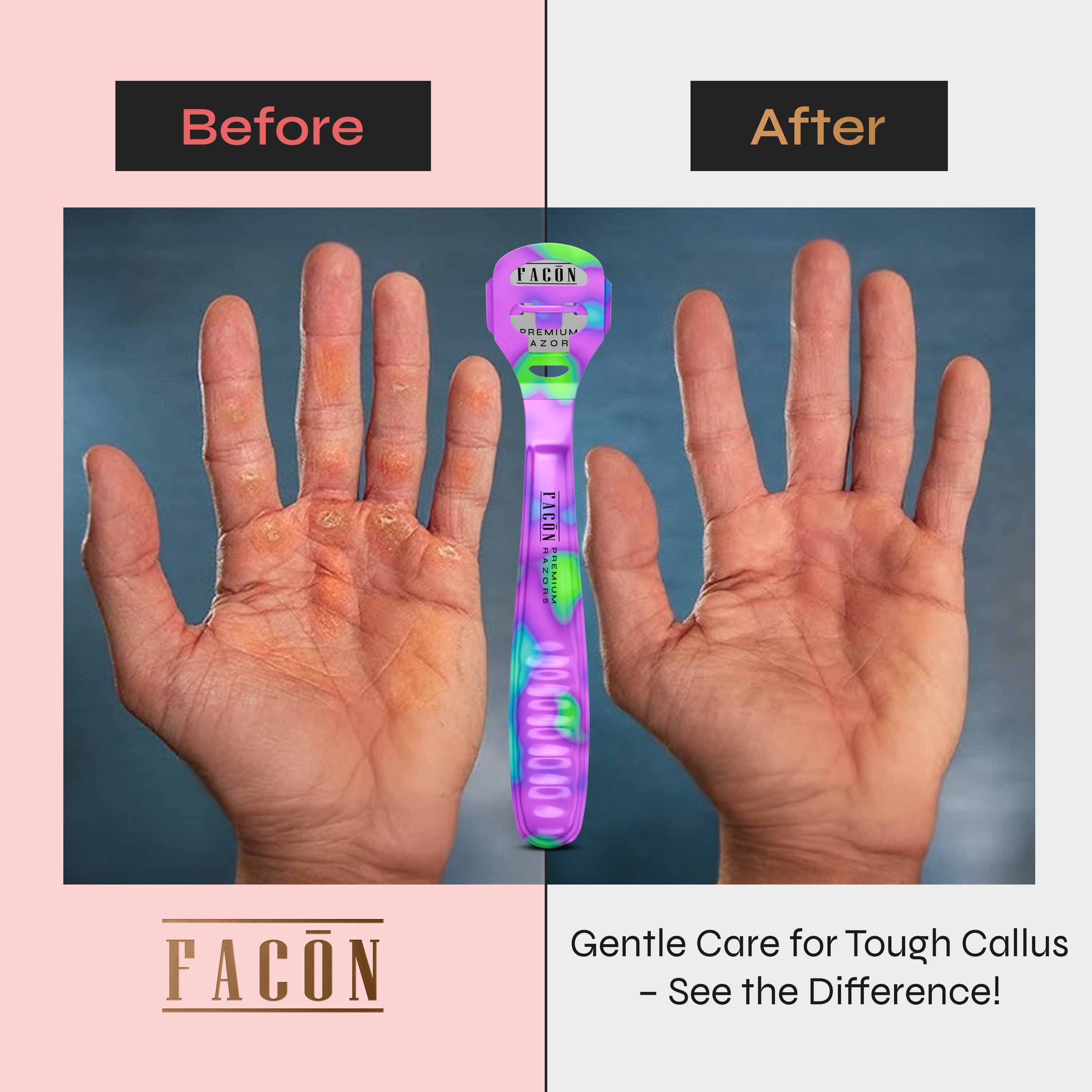 Facón Professional Callus Shaver Remover with 50 Blades, Pedicure Razor for Feet & Hands, Foot Razor for Callus Removal, Callus Blade Remover, Corn Shaver, Surgical Grade Premium Stainless Steel Tool