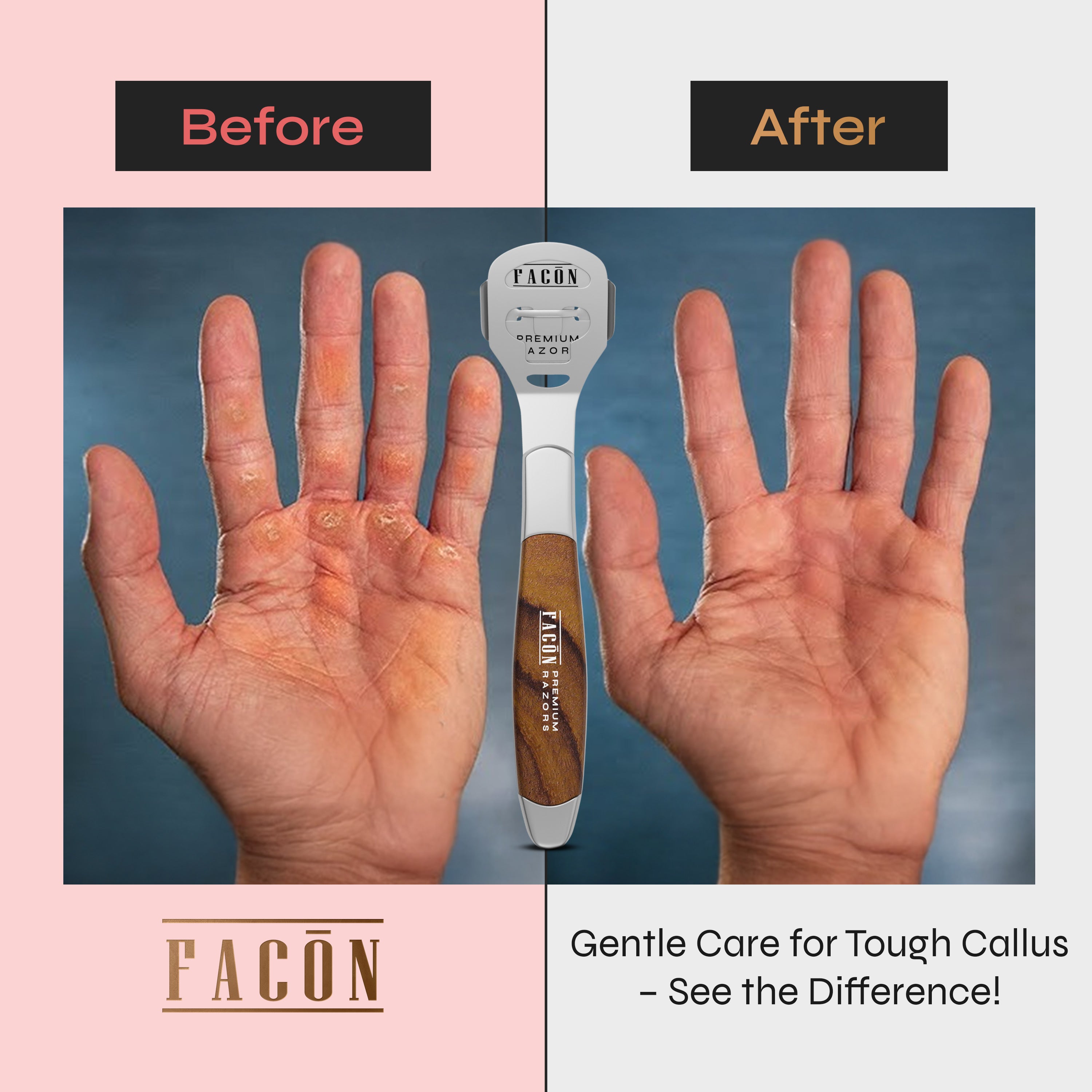 Facón Professional Callus Shaver Remover with 50 Blades, Pedicure Razor for Feet & Hands, Foot Razor for Callus Removal, Callus Blade Remover, Corn Shaver, Surgical Grade Premium Stainless Steel Tool