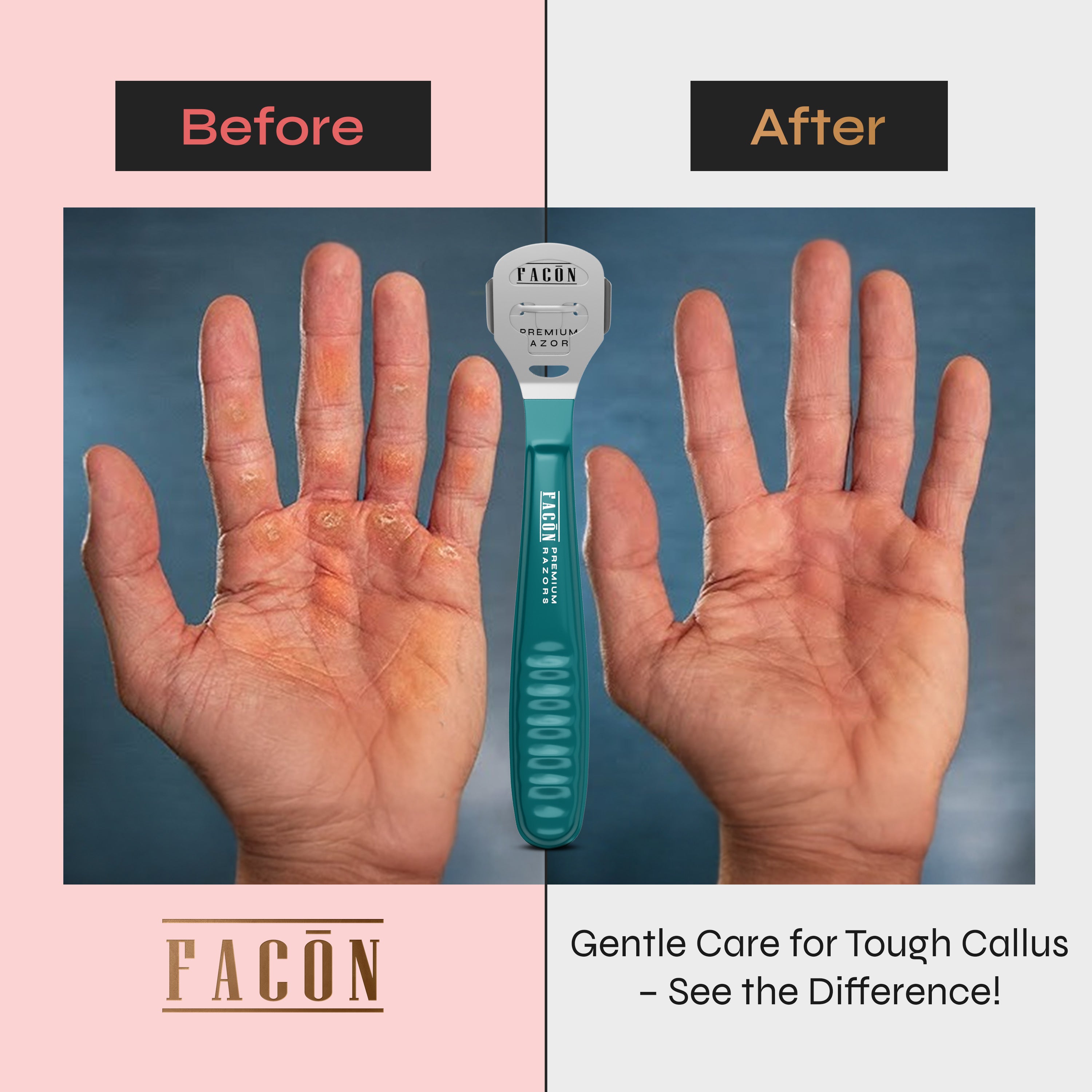 Facón Professional Callus Shaver Remover with 50 Blades, Pedicure Razor for Feet & Hands, Foot Razor for Callus Removal, Callus Blade Remover, Corn Shaver, Surgical Grade Premium Stainless Steel Tool