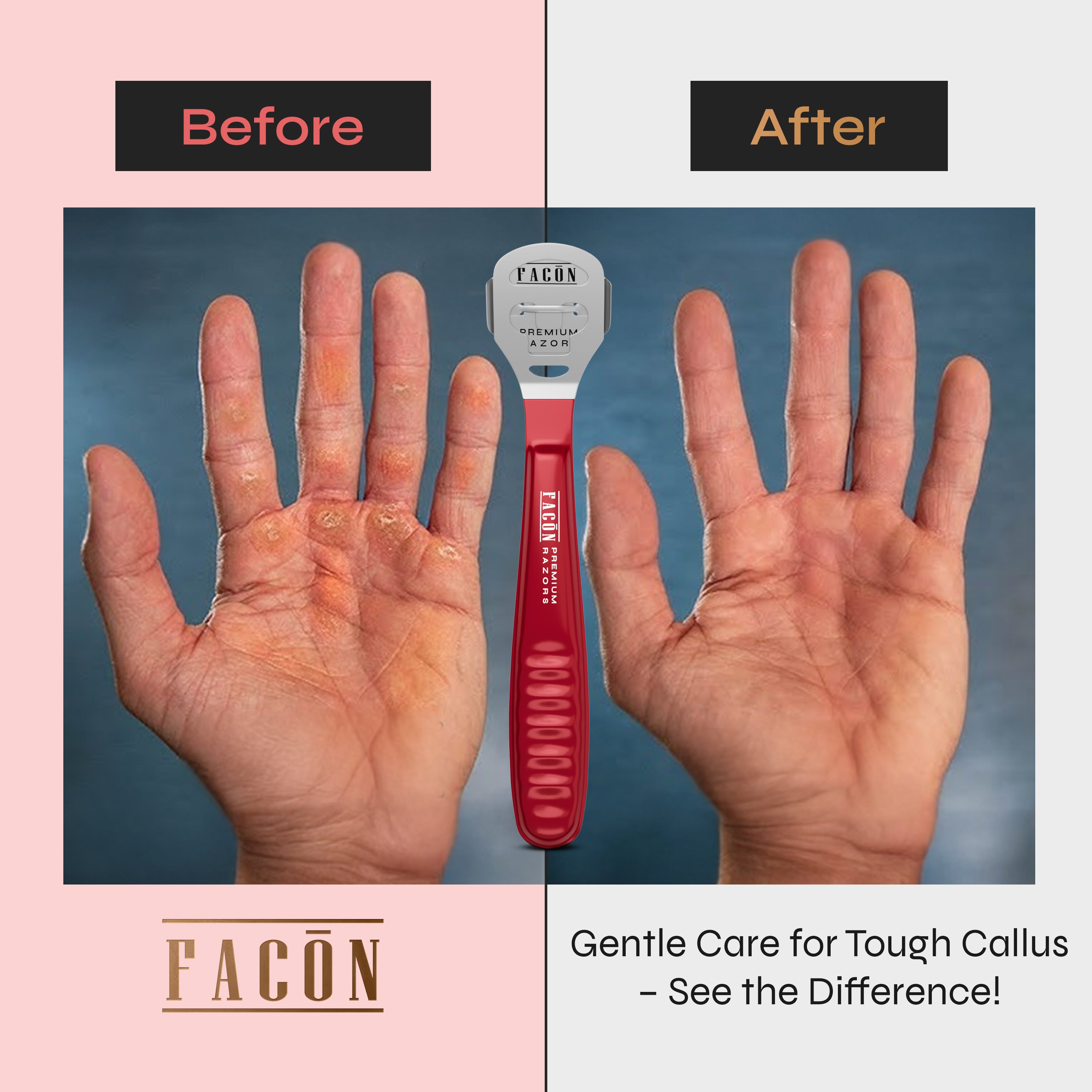 Facón Professional Callus Shaver Remover with 50 Blades, Pedicure Razor for Feet & Hands, Foot Razor for Callus Removal, Callus Blade Remover, Corn Shaver, Surgical Grade Premium Stainless Steel Tool