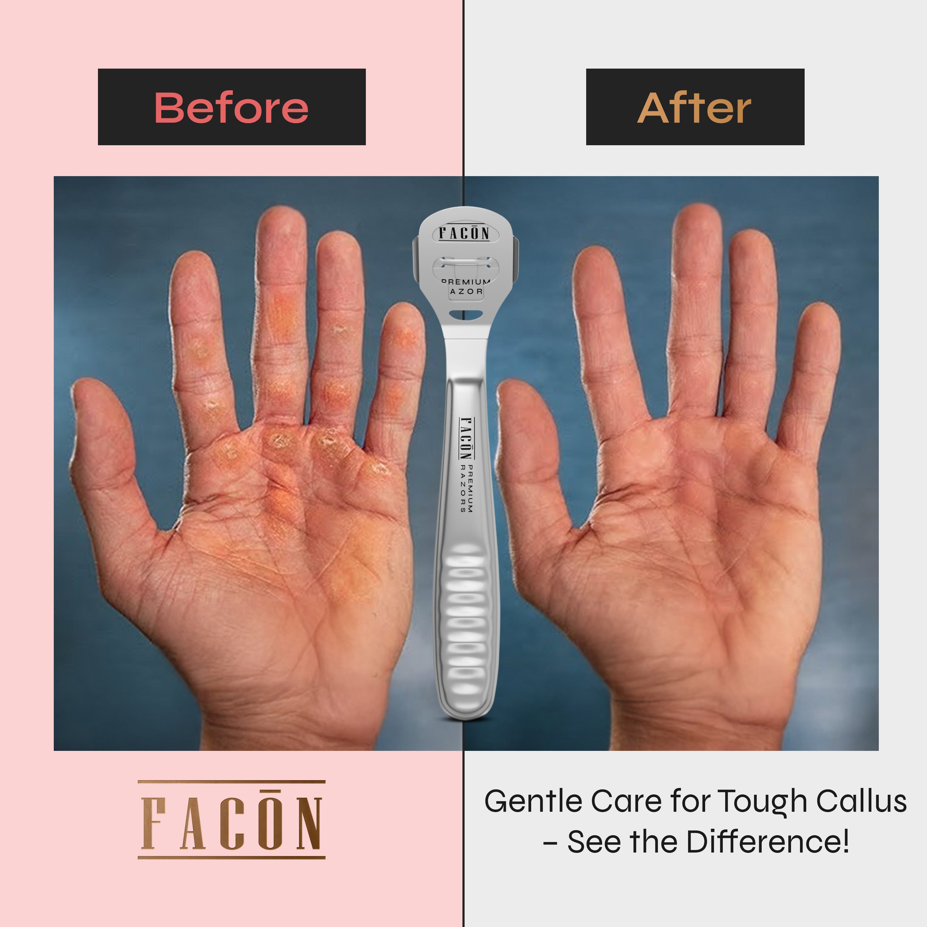 Facón Professional Callus Shaver Remover with 50 Blades, Pedicure Razor for Feet & Hands, Foot Razor for Callus Removal, Callus Blade Remover, Corn Shaver, Surgical Grade Premium Stainless Steel Tool