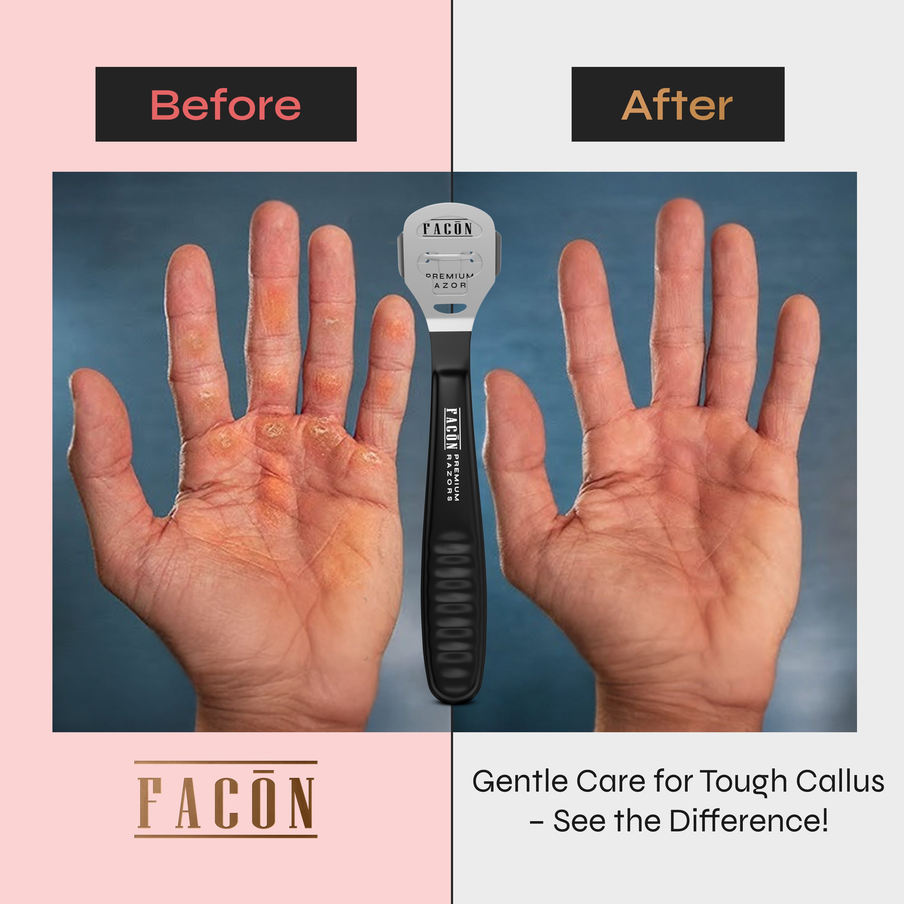 Facón Professional Callus Shaver Remover with 50 Blades, Pedicure Razor for Feet & Hands, Foot Razor for Callus Removal, Callus Blade Remover, Corn Shaver, Surgical Grade Premium Stainless Steel Tool